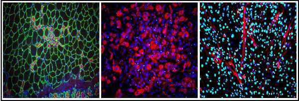 Le cellule oggetto dello studio condotto dall’Istituto di biologia e patologia molecolari del Consiglio nazionale delle ricerche (Cnr-Ibpm) sono le progenitrici fibro-adipogeniche, note con l’acronimo FAP, e rappresentano l’arma a doppio taglio del muscolo scheletrico. Queste cellule, infatti, in condizioni fisiologiche rilasciano dei fattori che aiutano le cellule staminali muscolari alla rigenerazione del muscolo. Nel corso della degenerazione che si verifica nei tessuti affetti da distrofia muscolare di Duchenne invece, le FAP danno origine all’infiltrato adiposo e fibrotico che rimpiazza progressivamente il tessuto muscolare, rendendolo meno funzionale. La ricerca portata avanti dal gruppo di Chiara Mozzetta insieme alle biologhe Beatrice Biferali e Valeria Bianconi, prime autrici del lavoro, è stato pubblicato su Science Advances e realizzata col sostegno del programma Scientific Independence of young Researchers (SIR) del Ministero dell’istruzione, università e ricerca (Miur) e dell’AFM-Telethon. “Abbiamo rivelato in che modo è possibile cambiare il destino di queste cellule riuscendo a spingerle a formare nuovo tessuto muscolare e bloccando quindi la loro capacità di generare cellule fibrotiche e adipose”, spiega Mozzetta. “Sapevamo da studi precedenti che le FAP sono capaci di acquisire diverse identità a seconda dell’ambiente in cui si vengono a trovare e in questo lavoro abbiamo capito come riconvertirle in cellule in grado di partecipare alla rigenerazione muscolare, piuttosto che alla degenerazione”. Le studiose hanno rivelato che i geni responsabili dell’acquisizione della capacità di formare nuovo tessuto muscolare sono confinati alla periferia del nucleo delle FAP, dove vengono relegate quelle porzioni del genoma che non sono utilizzate dalle cellule. “La proteina Prdm16 gioca un ruolo cruciale nel bloccare le regioni di DNA codificanti il potenziale muscolare delle FAP alla periferia nucleare, reclutando su di esse gli enzimi G9a e GLP per mantenerle silenti”, specifica la ricercatrice Cnr-Ibpm. “Abbiamo provato quindi a sbloccare queste regioni utilizzando un approccio farmacologico volto ad inibire G9a/GLP, riuscendo a dimostrare che togliendo questo ‘freno’ molecolare questi geni possono essere rilocalizzati dalla periferia verso una parte più attiva del nucleo, sbloccando la capacità delle FAP di formare tessuto muscolare”. Lo studio potrebbe aprire la strada a un approccio di tipo farmacologico per quelle patologie, come la distrofia muscolare di Duchenne, in cui le FAP contribuiscono alla degenerazione muscolare. Alla ricerca hanno collaborato gruppi dell’Università Sapienza di Roma, dell’Istituto italiano di tecnologia (Iit) di Roma, dell’Istituto Europeo di Oncologia (Ieo) di Milano, della Freie Universität di Berlino e l’Irbm di Pomezia.
