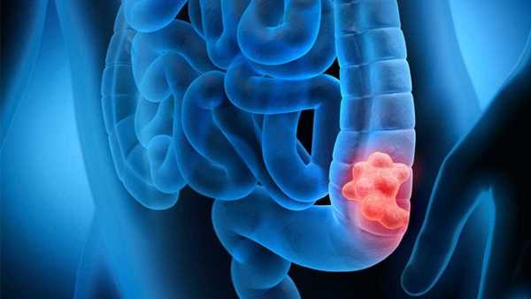 Un nanosistema per contrastare il tumore al colon