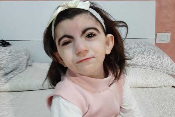 Sindrome di Cornelia de Lange: nuova luce sui processi molecolari