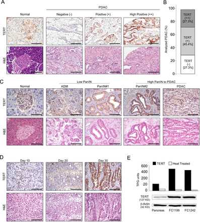 Nuove prospettive per la cura del tumore del pancreas